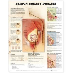 Benign Breast Disease Anatomical Chart – Soft Laminate