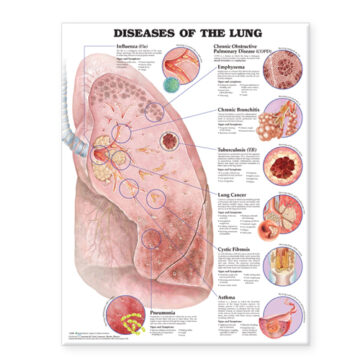 Diseases of the Lung Anatomical Chart - Soft Laminate