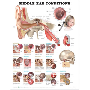 Middle Ear Conditions Anatomical Chart – Soft Laminate