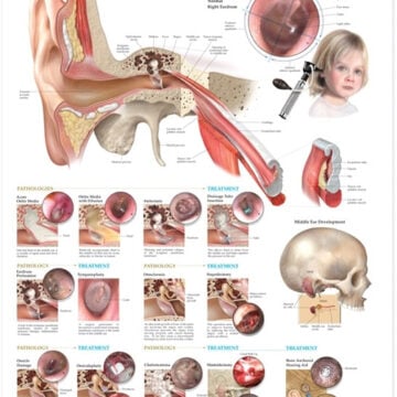 Middle Ear Conditions Anatomical Chart - Soft Laminate
