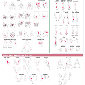 Travell, Simons & Simons’ Trigger Point Pain Patterns Wall Chart: Head, Neck, and Upper Limb - Soft Laminate
