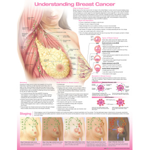 Understanding Breast Cancer Anatomical Chart – Soft Laminate
