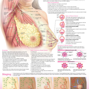 Understanding Breast Cancer Anatomical Chart - Soft Laminate