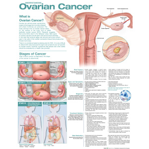 Understanding Ovarian Cancer Anatomical Chart – Soft Laminate