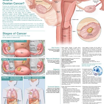 Understanding Ovarian Cancer Anatomical Chart - Soft Laminate