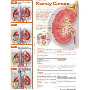 Understanding Kidney Cancer Anatomical Chart – Soft Laminate