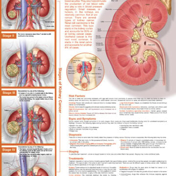 Understanding Kidney Cancer Anatomical Chart - Soft Laminate