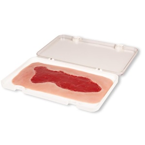 Wound moulage venous leg ulcer, large, granulation phase