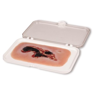 Wound moulage arterial leg ulcer, small, exudation phase