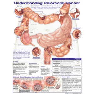 Understanding Colorectal  Cancer Anatomical Chart – Soft Laminate