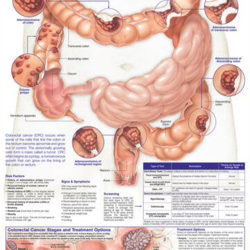 Understanding Colorectal Cancer Anatomical Chart - Soft Laminate