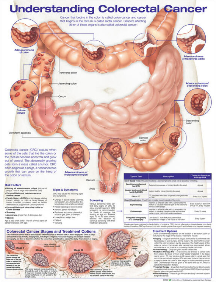 Understanding Colorectal Cancer Anatomical Chart - Soft Laminate