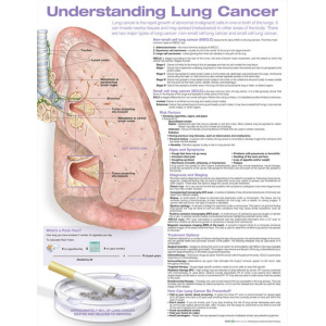 Understanding Lung Cancer Anatomical Chart – Soft Laminate