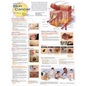 Understanding Skin Cancer Anatomical Chart – Soft Laminate
