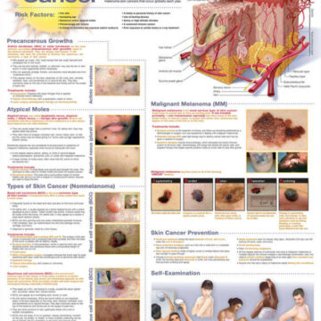 Understanding Skin Cancer Anatomical Chart - Soft Laminate