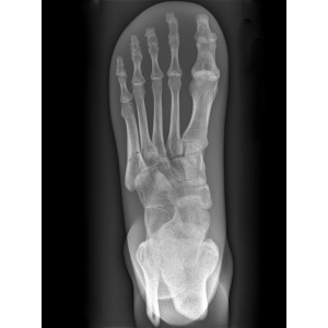 X-Ray Phantom Foot, opaque