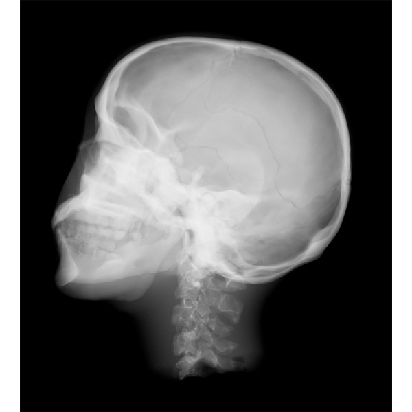 Sectional Xray phantom with artificial bones Head phantom