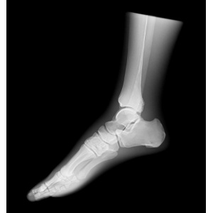 Sectional X-ray phantom with artificial bones – Left foot, transparent