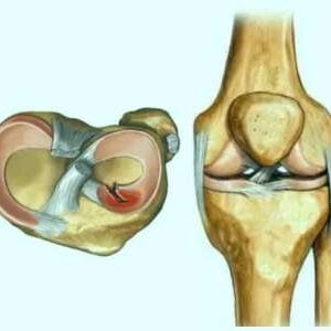 Meniscal Injuries