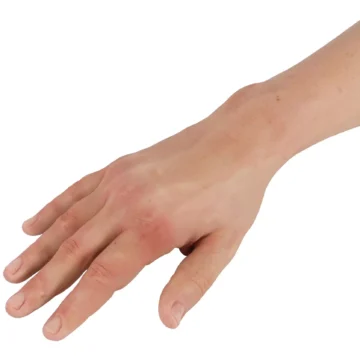Puncture Pete – hyperrealistic IV training arm, light skin color