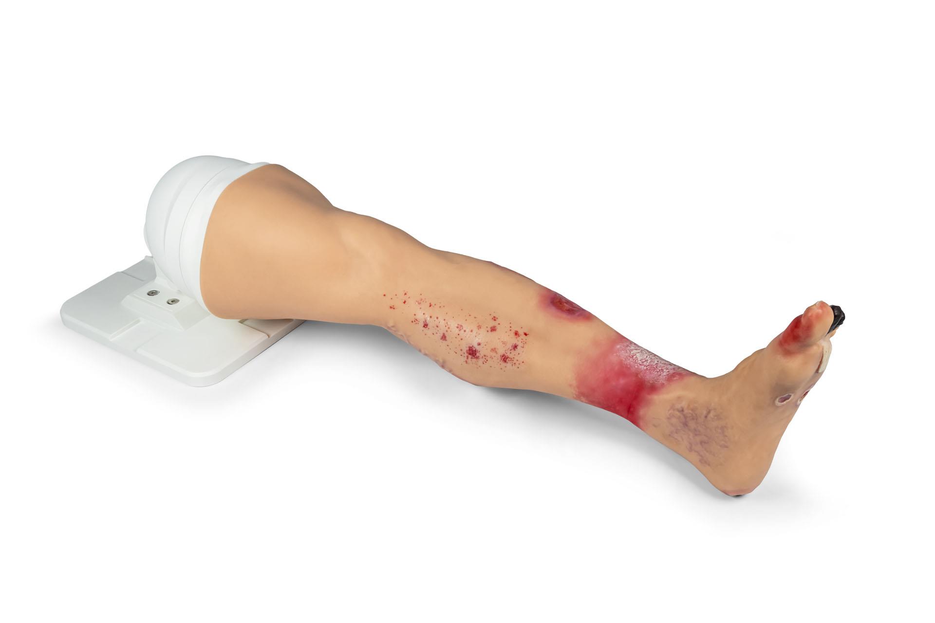 "Lena Leg" - Leg with medical conditions "Lena Leg" - Leg with medical conditions