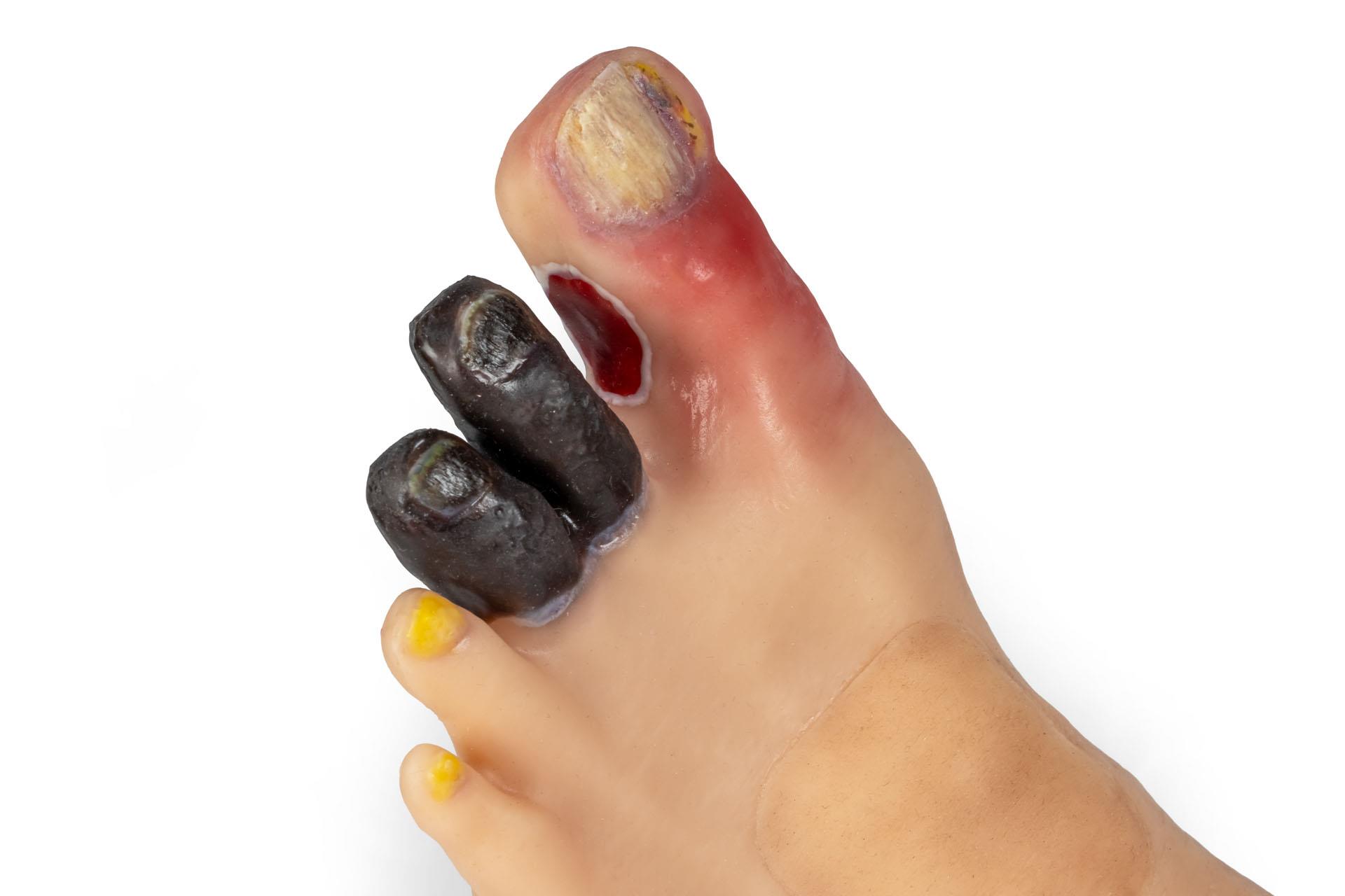 "Lena Leg" - Leg with medical conditions "Lena Leg" - Leg with medical conditions