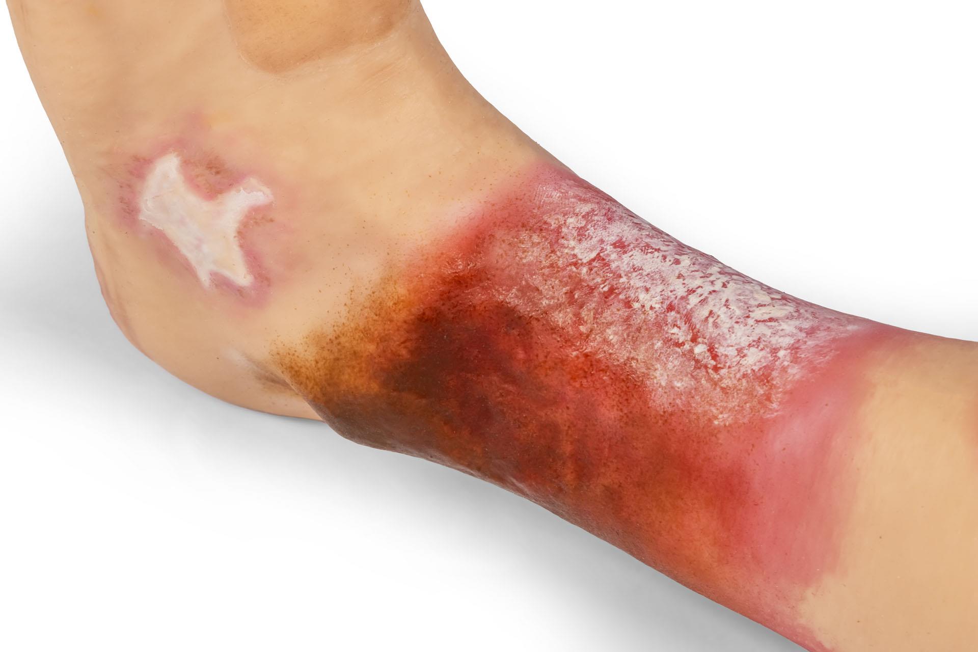 "Lena Leg" - Leg with medical conditions "Lena Leg" - Leg with medical conditions