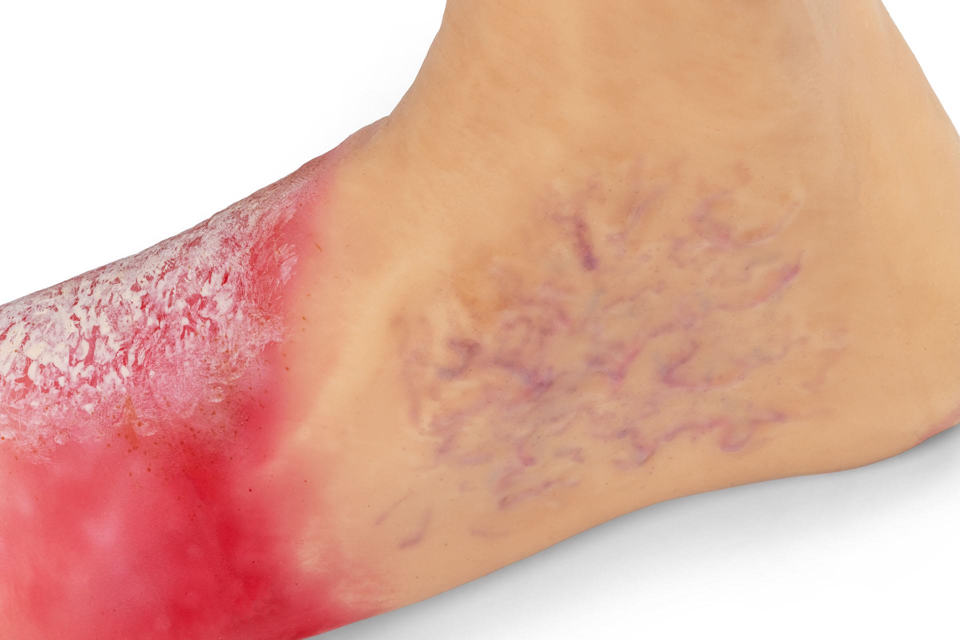 "Lena Leg" - Leg with medical conditions "Lena Leg" - Leg with medical conditions