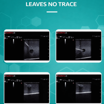 Breast Ultrasound-Guided Biopsy Training Model