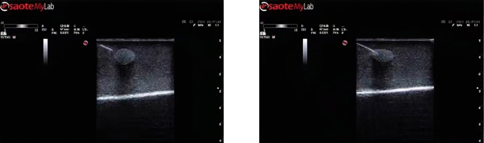 DS-40203 - Breast Ultrasound-Guided Biopsy Training Model Breast Ultrasound-Guided Biopsy Training Model