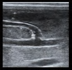 DS-40301 - Ultrasound-Guided Radial Artery Puncture Model Ultrasound-Guided Radial Artery Puncture Model