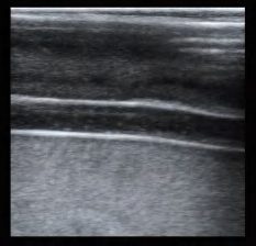 DS-40301 - Ultrasound-Guided Radial Artery Puncture Model Ultrasound-Guided Radial Artery Puncture Model