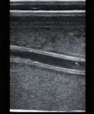 DS-40302 - Ultrasound-Guided Femoral Artery Puncture Model Ultrasound-Guided Femoral Artery Puncture Model