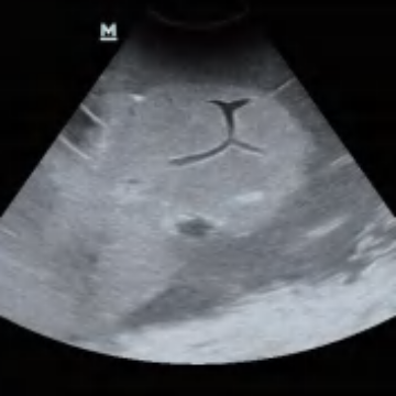 Ultrasound-Guided Liver Puncture Model