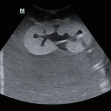 Ultrasound-Guided Percutaneous Renal Puncture Model