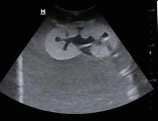 DS-40304 - Ultrasound-Guided Percutaneous Renal Puncture Model Ultrasound-Guided Percutaneous Renal Puncture Model