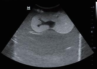 DS-40304 - Ultrasound-Guided Percutaneous Renal Puncture Model Ultrasound-Guided Percutaneous Renal Puncture Model
