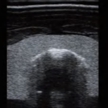 Ultrasound-Guided Thyroid Puncture Model (Advanced)