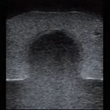 Ultrasound-Guided Thyroid Puncture Model
