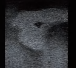 DS-40306 - Ultrasound-Guided Thyroid Puncture Model Ultrasound-Guided Thyroid Puncture Model