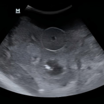 Transrectal Prostate Ultrasound Model