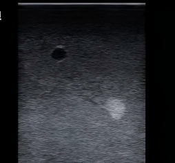 DS-40404 - Ultrasound-Guided Breast Biopsy Model Ultrasound-Guided Breast Biopsy Model