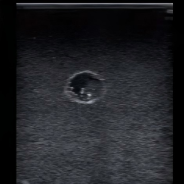 Ultrasound-Guided Breast Biopsy Model (Advanced)