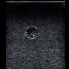 DS-40405 - Ultrasound-Guided Breast Biopsy Model (Advanced) Ultrasound-Guided Breast Biopsy Model (Advanced)