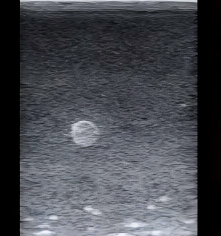 DS-40405 - Ultrasound-Guided Breast Biopsy Model (Advanced) Ultrasound-Guided Breast Biopsy Model (Advanced)