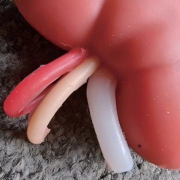 Kidney Lesion Model