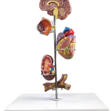 Effects of Hypertension, 5 Parts