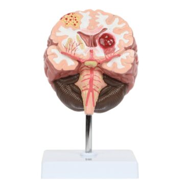 Brain Pathologies, Stroke, Life Size, 1 Part