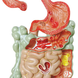 Pathological Model of the Digestive System, 1/4 Life Size, 2 Parts