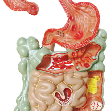 Pathological Model of the Digestive System, 1/4 Life Size, 2 Parts
